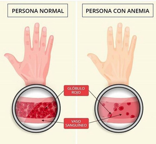 Anemias Definición Y Generalidades - Revista Toxicshock